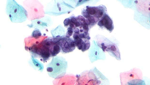 Herpes Simplex